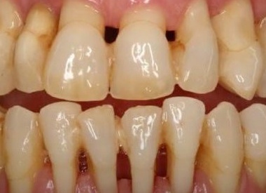 Как вовремя заметить пародонтоз и не потерять зубы